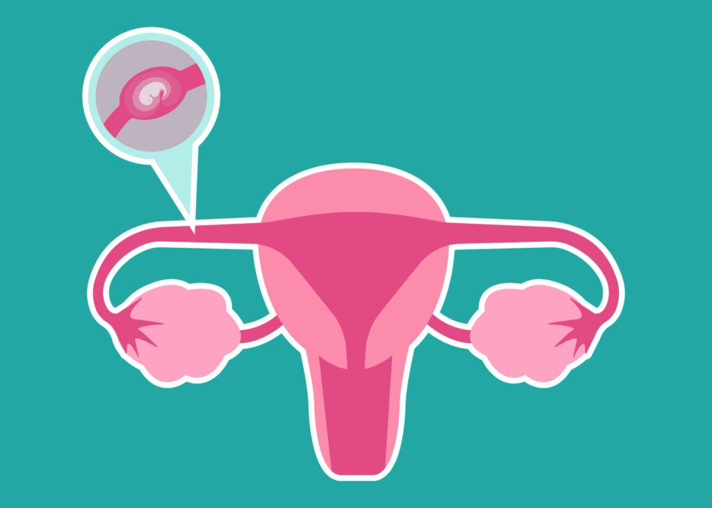 What is an Ectopic Pregnancy? Alcove Health Women's Clinic
