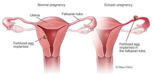 How Long Can I Wait to get an Abortion? - Alcove Health Women's Clinic Newport News, VA